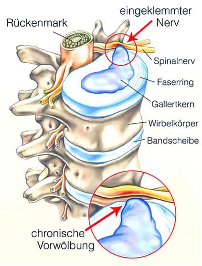Nackenschmerzen wegen eingeklemmtem Nerv: Ursachen und Behandlung